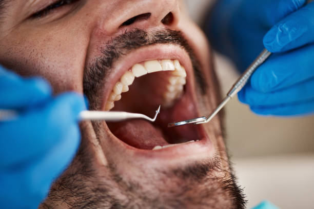 Best Emergency Wisdom Teeth Removal in Linden, AZ